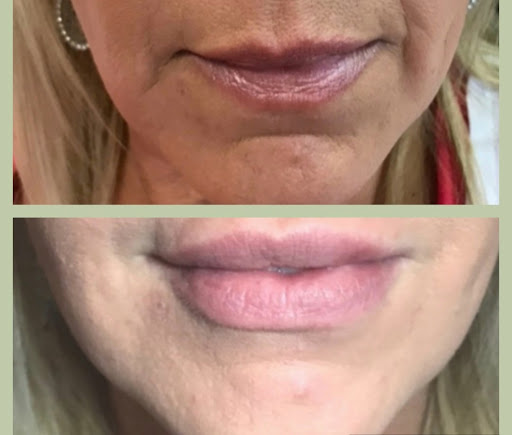 Nurse Judy- Botox & Beyond
