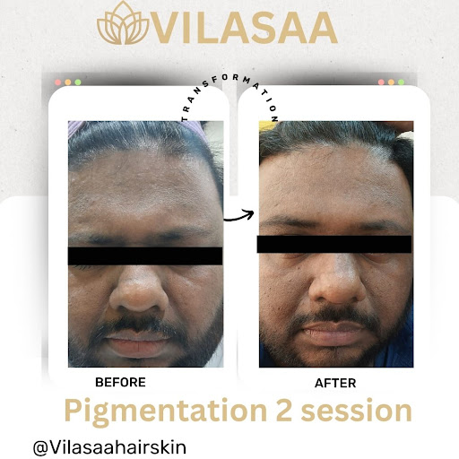 If you're struggling with pigmentation, don't hesitate to consult with a professional. Visiting V…