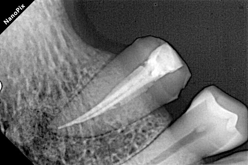 Forget the old horror stories of visiting the dentist four times for a single tooth. Dr. Aditya D… post image