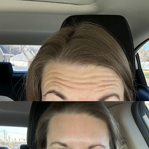 The Mercedes of Botox at Smiley Aesthetics Mount Juliet - Thumbnail