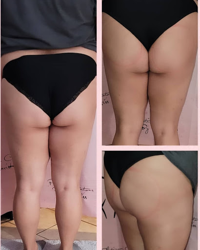Body Sculpting - Thumbnail