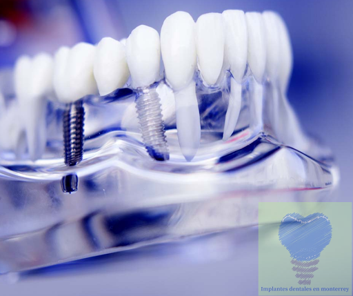 Implantes Dentales en Monterrey Dr Xavier Madrigal - Thumbnail