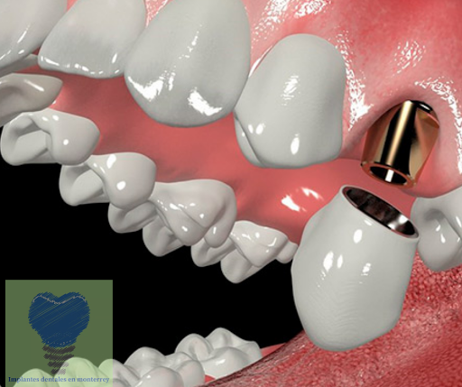 Implantes Dentales en Monterrey Dr Xavier Madrigal - Thumbnail