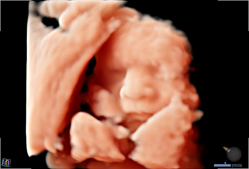 ULTRASONIDO EN CANCUN, 5D, 4D Y 3D.