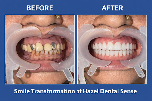 We successfully completed a full mouth rehabilitation and smile designing case, giving our patien… post image
