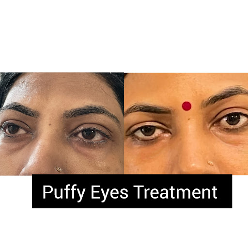 Puffy eyes can be treated easily with the latest technology.