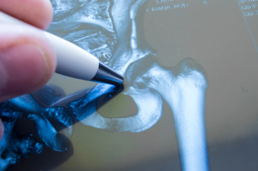 Building Bone Strength: The Vital Role of Physiotherapy in Managing Osteoporosis 💪🦴 post image
