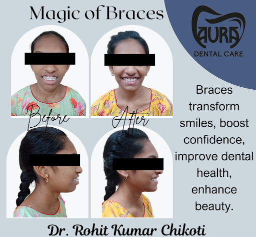 Transform your smile with expert orthodontic treatment from Dr. Rohit Kumar Chikoti, a specialist… post image