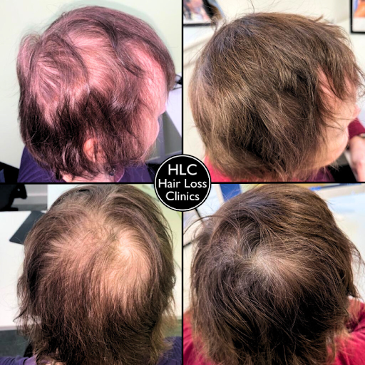 Cardiff Hair Loss Clinic - Thumbnail