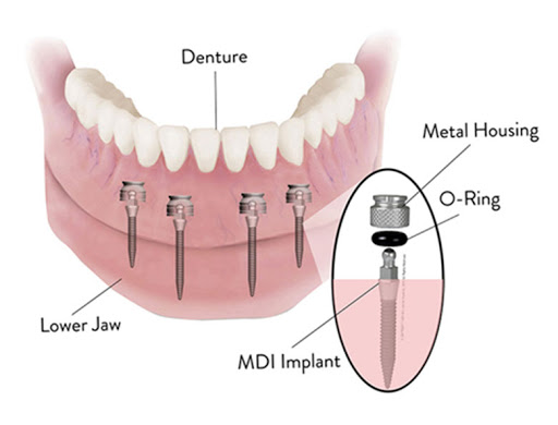 Dental Implant Solutions Eden, NY