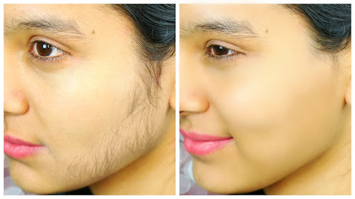 ✨ Laser Hair Reduction – Before & After Transformation at Twak Aesthetics ✨ post image