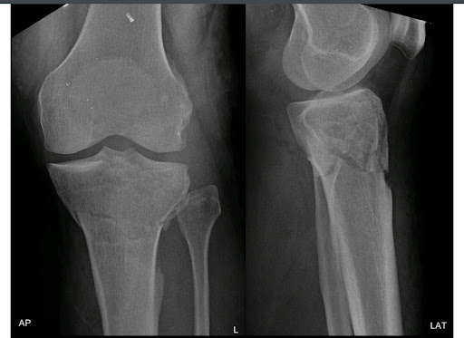 Proximal tibia fracture with plating post image