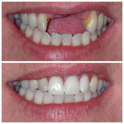Our Tooth Replacement Options: post image