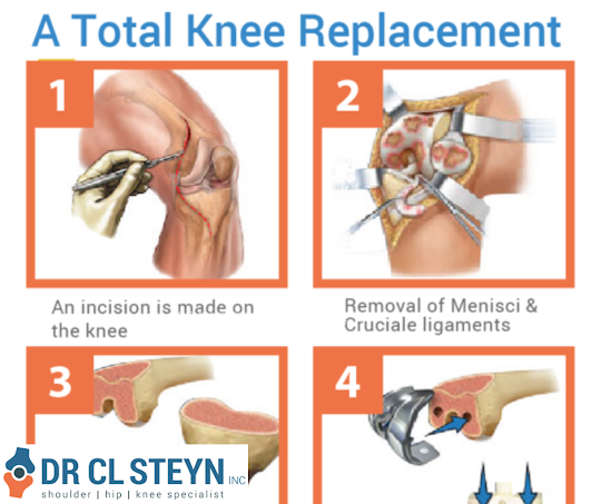 knee replacement surgery