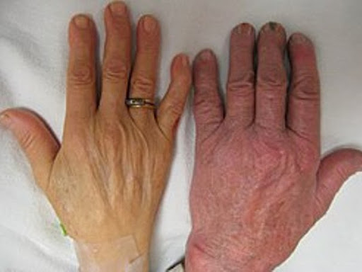 ANEMIA -LOW HEMOGLOBIN- HOMEOPATHY post image