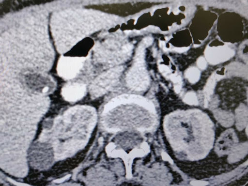 Don't ignore abdominal pain 