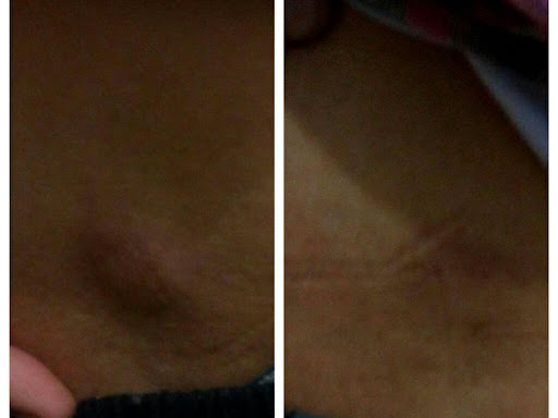 Case of sebaceous Cyst since a long time completely disappeared in few weeks time. post image