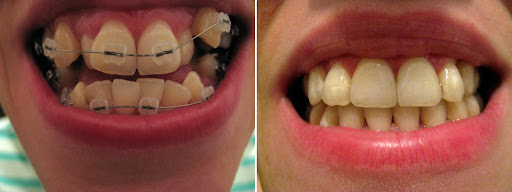 Braces fixed orthodontic treatment