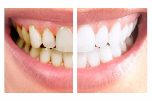 Brushing your teeth twice a day is crucial for maintaining oral health. Use a soft-bristled tooth… post image