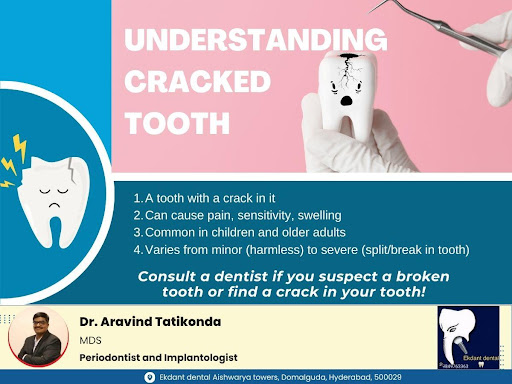 Cracked Tooth: What is it? post image