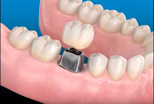 Clínica Dental Casher - Dentista Alicante - Thumbnail