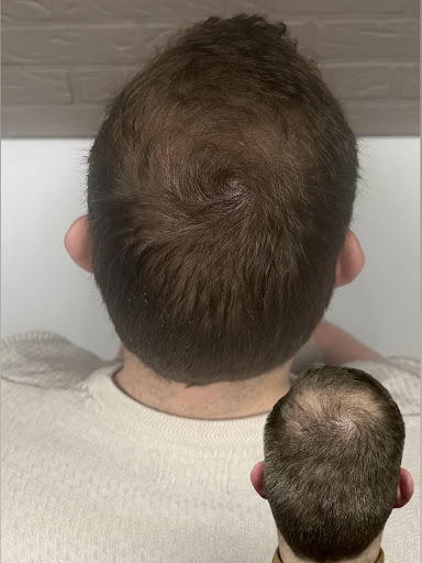 MHP Hair Solutions | SMP | Hair Tattoo - Thumbnail