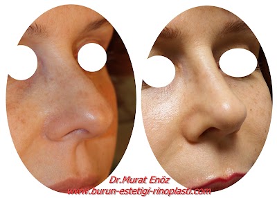 Photos of Dr. Murat En&ouml;z, ENT Doctor, Burun Estetiği, Tip Plasty, Rhinoplasty, Nose Job Surgery, Istanbul