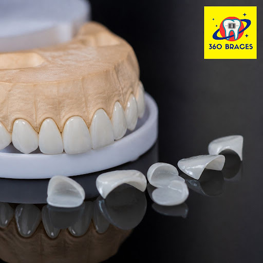 Dreaming of a flawless smile without aggressive drilling? At 360 BRACES Dental Clinic in Laxminag… post image