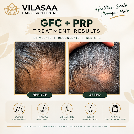 GFC + PRP Hair Treatment Results at Vilasaa Hair & Skin Centre