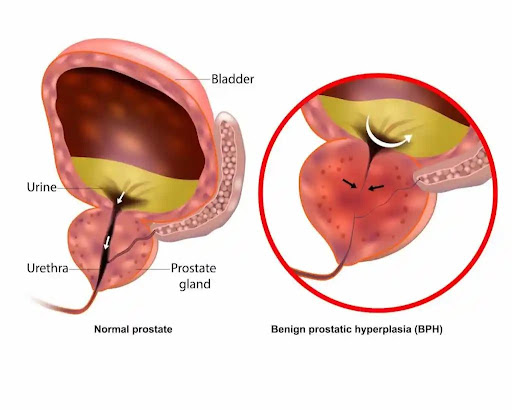 PROSTATE AND HOMEOPATHY post image