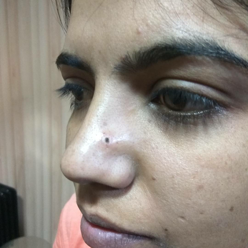 Mole removal