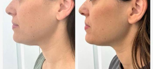 🔥 Targeted Fat Loss Treatments in Sector 49 Gurgaon post image