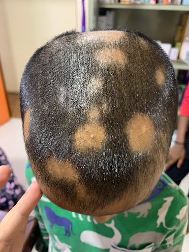 Alopecia treatments available (patchy hair loss)