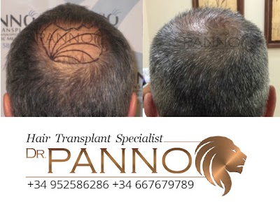 Photos of Hair Transplant Gibraltar Dr. Panno