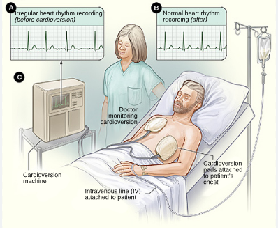 Cardioversion is a medical procedure used to help restore a normal heart rhythm when someone has… post image