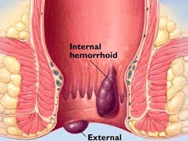 PILES HOMEOPATHIC TREATMENT  post image