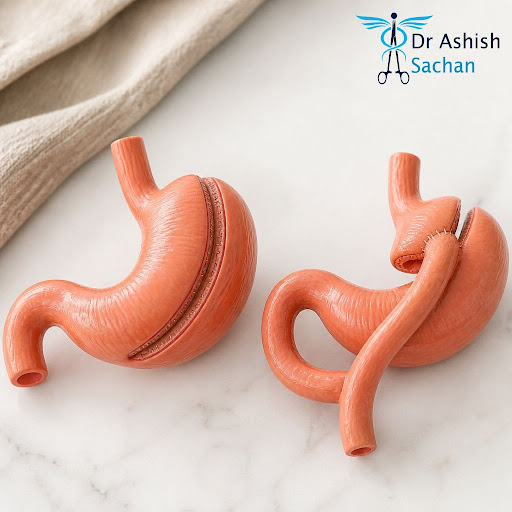 Thinking about weight loss surgery but confused between sleeve gastrectomy and gastric bypass? At… post image