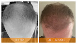 Hair transplant clinic Nashville Hair Doctor in Brentwood