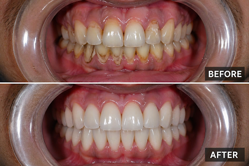 Check out this incredible before-and-after result! Expertly crafted by our smile design expert, D… post image
