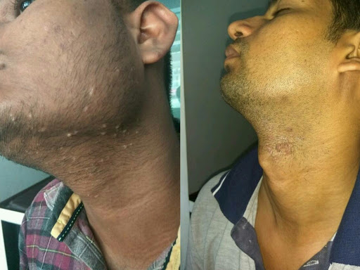 WARTS post image