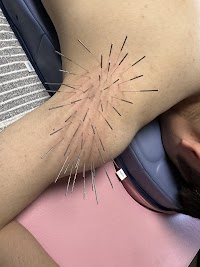 HARI CARE AURUM 鍼治療