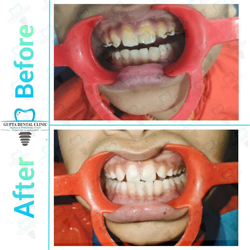 🦷Professional Dental Cleaning in Loni, Ghaziabad – Gupta Dental Clinic post image