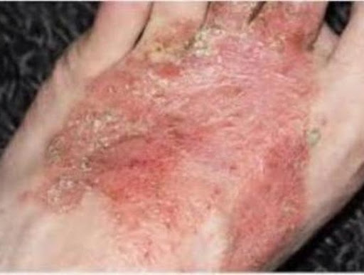 Homeopathic and eczema post image