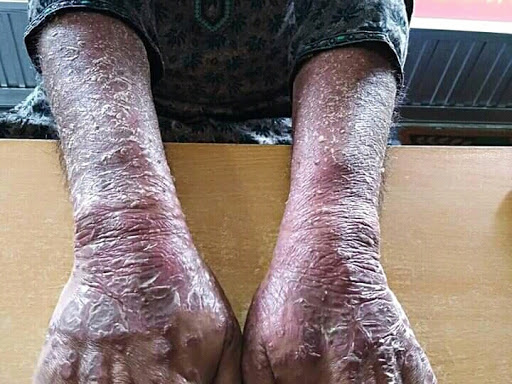 Cured within 5 weeks (Dr Soumya Dey's Clinic desk)  post image