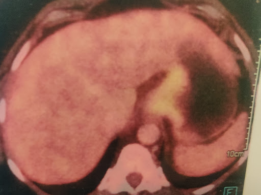 A 51 year old female having complaints of dysphagia ( difficulty in swallowing) for 2 months. On…