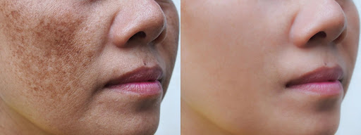 ✨ Troubled by Pigmentation? Restore Your Natural Glow post image