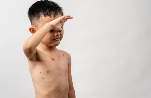 Chickenpox: Causes, Symptoms, and Prevention post image