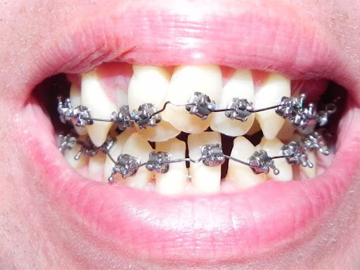 #braces doctor in Gorakhpur, post image