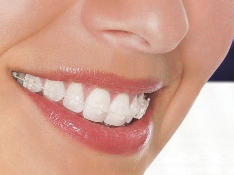 Self-ligating braces come either in traditional metal, ceramic, or clear brackets, and are made f…