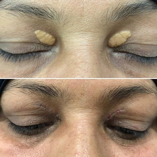 👁️ Yellowish Deposits Around Eyes? It Could Be Xanthelasma post image